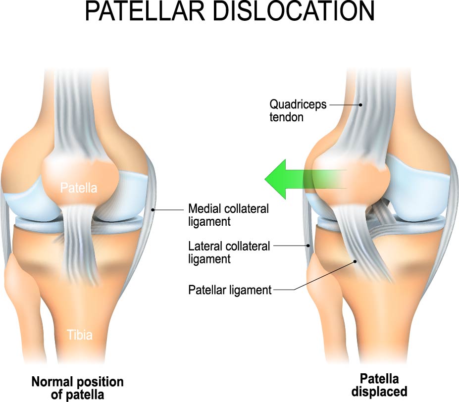 Diagram of a patella dislocation
