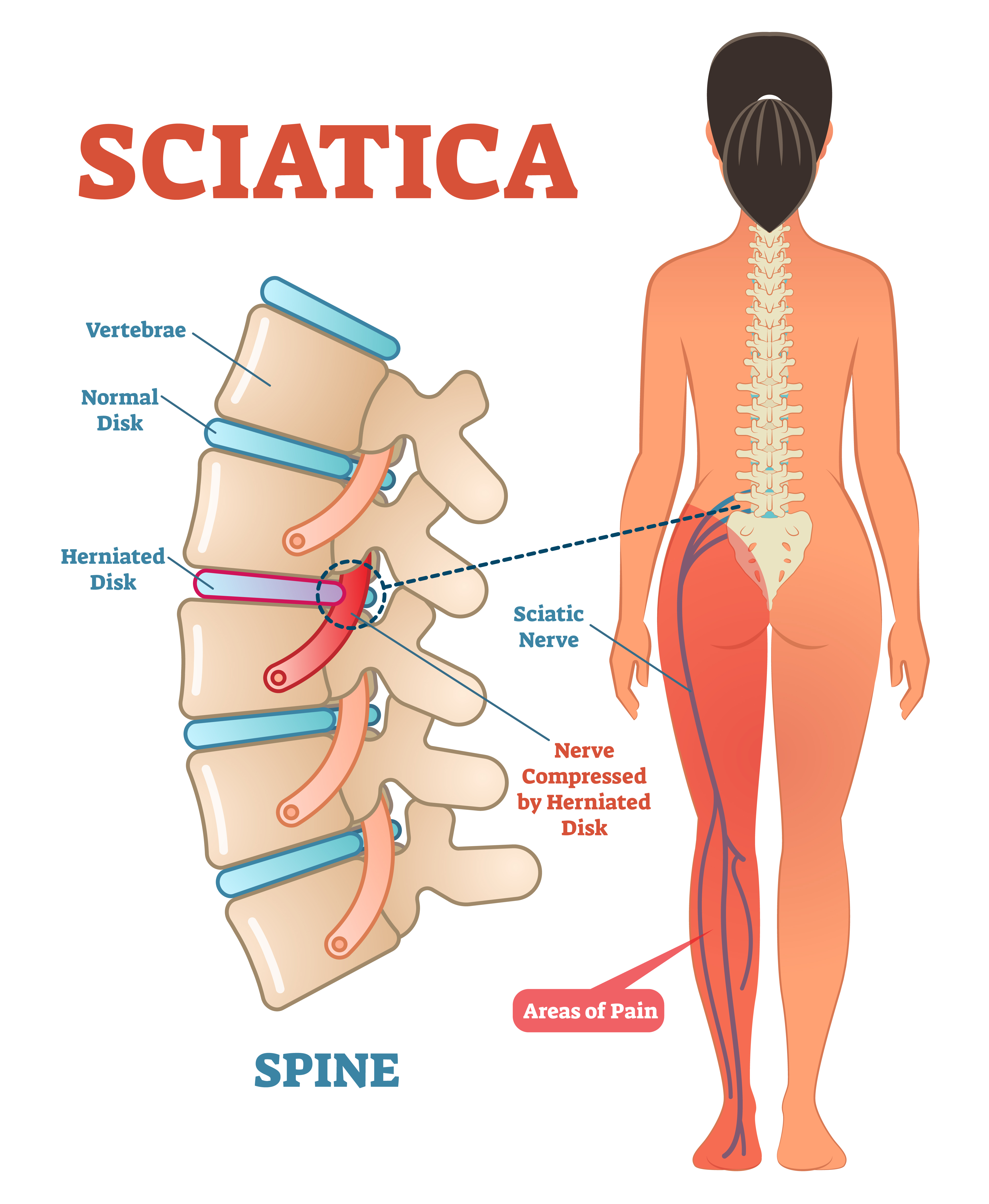 Diagram of Sciatica