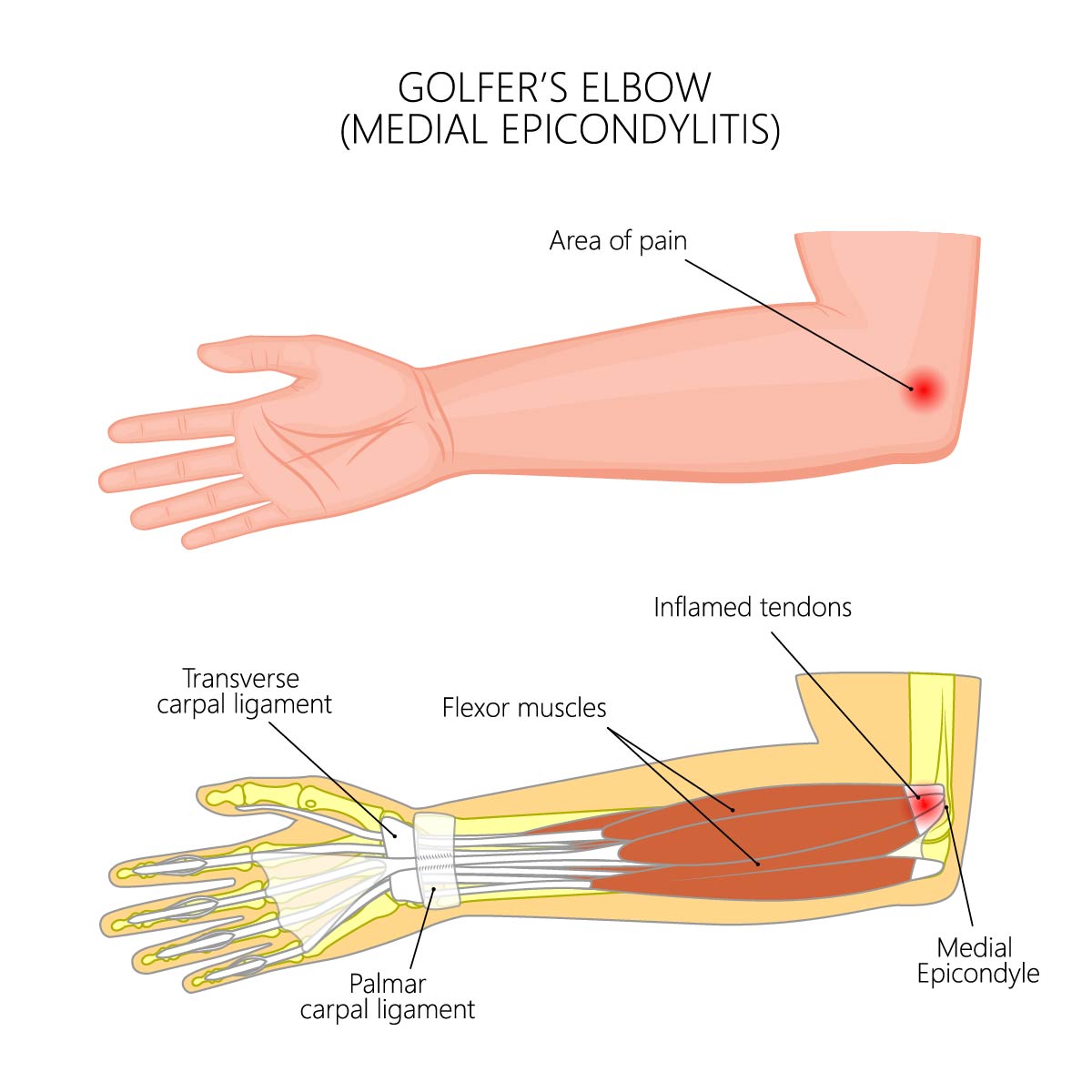 Diagram showing Golfer's Elbow